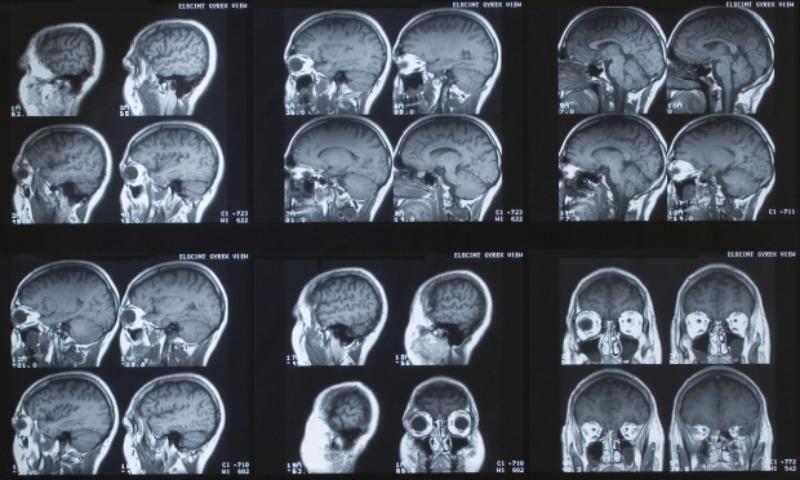 MRI of the brain