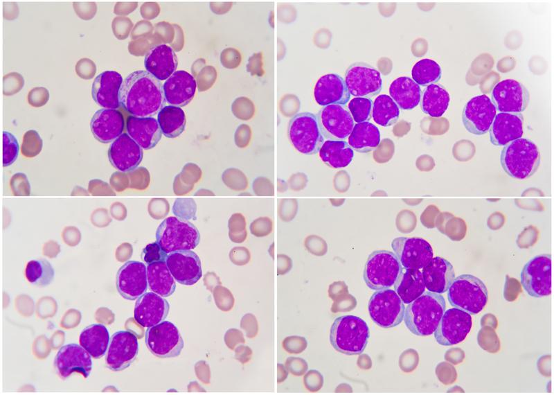 Leukemia , human blood cell under microscope. Emerging research on acute myelogenous leukemia shows promise.