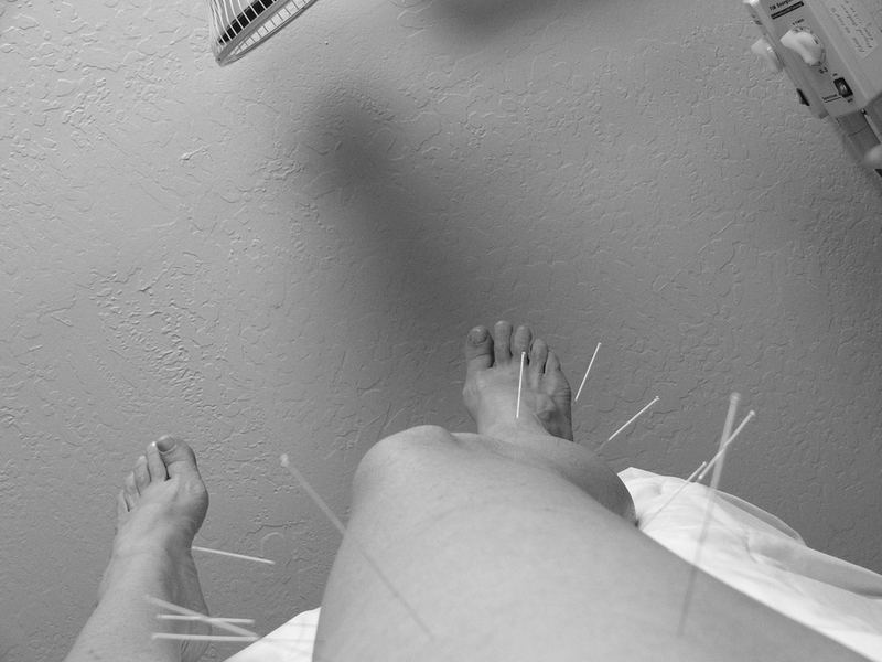 An acupuncture session.