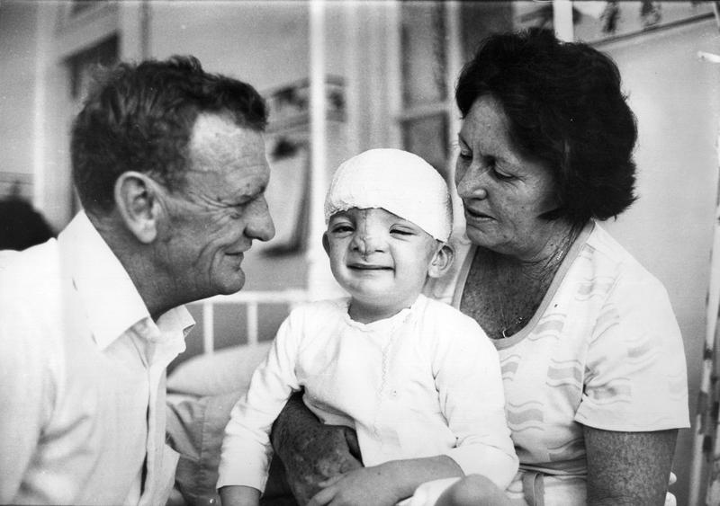 Doctors removed a large tumor from Robert Hoge's face when he was a baby, but the removal distorted his features.